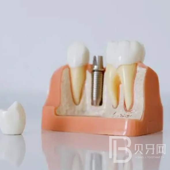 杭州種植一顆假牙多少錢！桐廬付現(xiàn)生口腔診所種植牙醫(yī)院排名TOP1，瑞典諾貝爾種植牙：5417元起/顆！