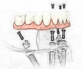 東莞好佰年口腔all on-4種植牙怎么樣？