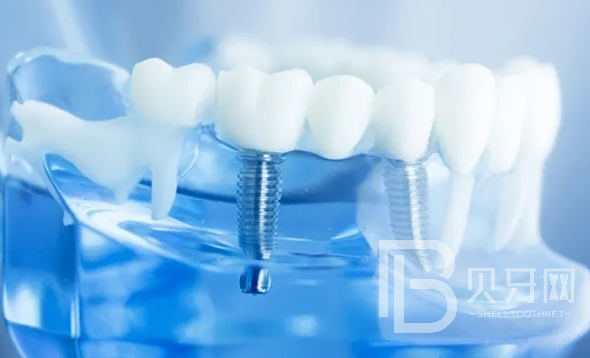 東莞牙博士口腔可以做種植牙嗎？
