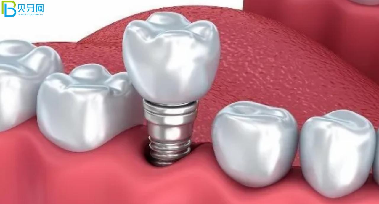 裝假牙怎么能少的了唯美口腔,聽說鑲牙3500元起?