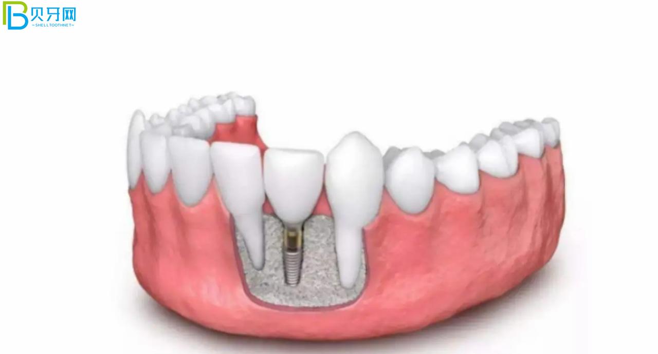 裝假牙怎么能少的了唯美口腔,聽說鑲牙3500元起?
