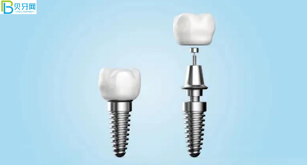 裝假牙怎么能少的了唯美口腔,聽說鑲牙3500元起?