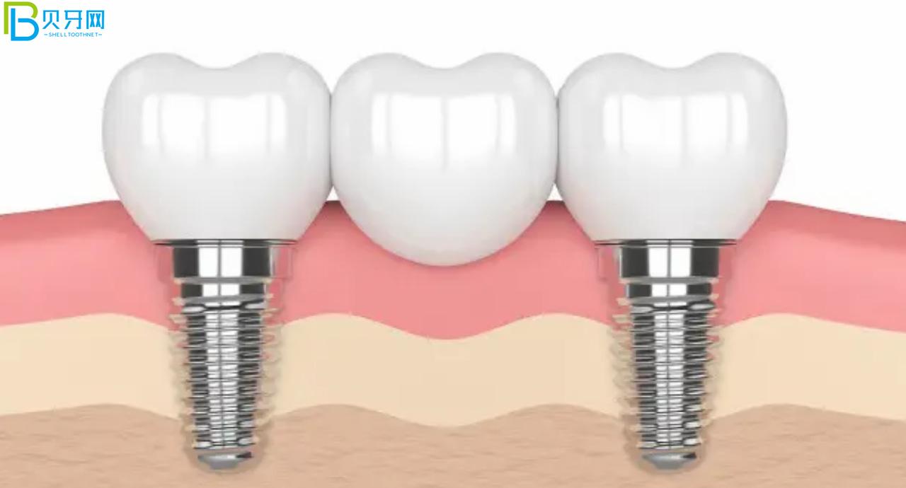 裝假牙怎么能少的了唯美口腔,聽說鑲牙3500元起?